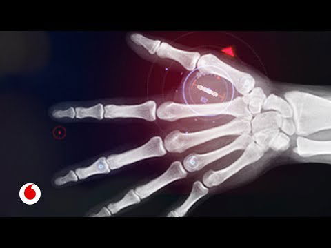 Una empresa sueca implanta microchips a sus empleados